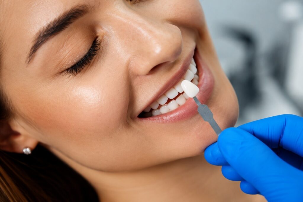 Faccette dentali: cosa sapere prima di rifarsi il sorriso
